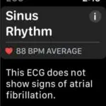 sinus rhythm ecg result on apple watch